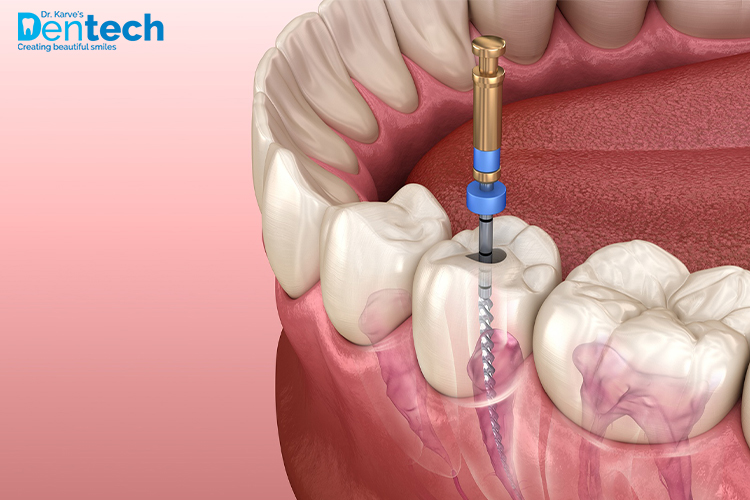 What is a Root Canal?