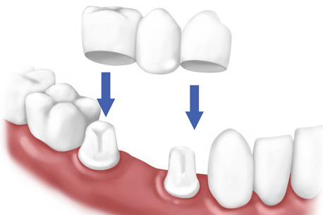 Dental Crowns & Bridges | Natural teeth