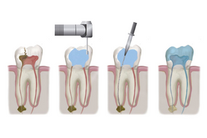 Root Canal Treatment in Thane, Mumbai -Dentech