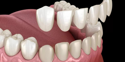 Dental Veneer in Powai