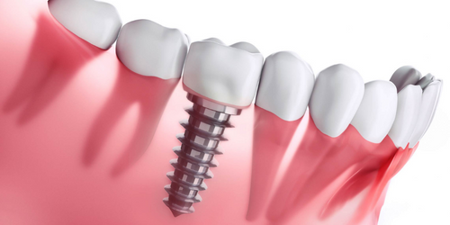 Dental Implant in Powai