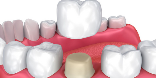 Dental Crown in Powai