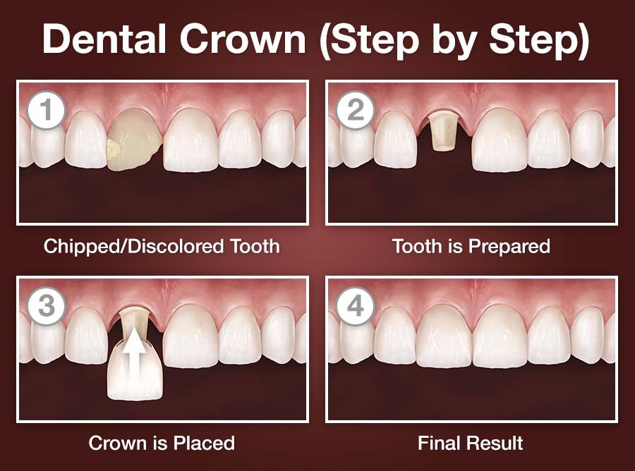 Teeth Capping Procedure - Dentech