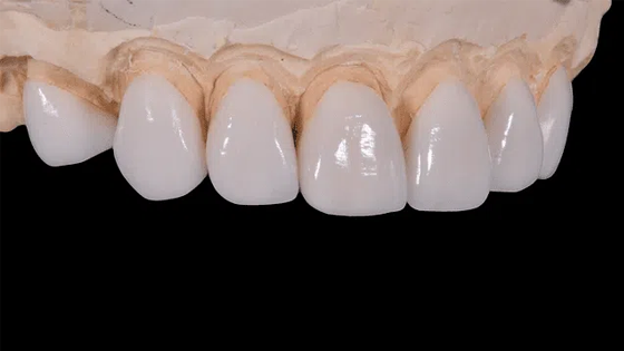 Porcelain Veneers