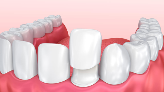 No-prep Veneers
