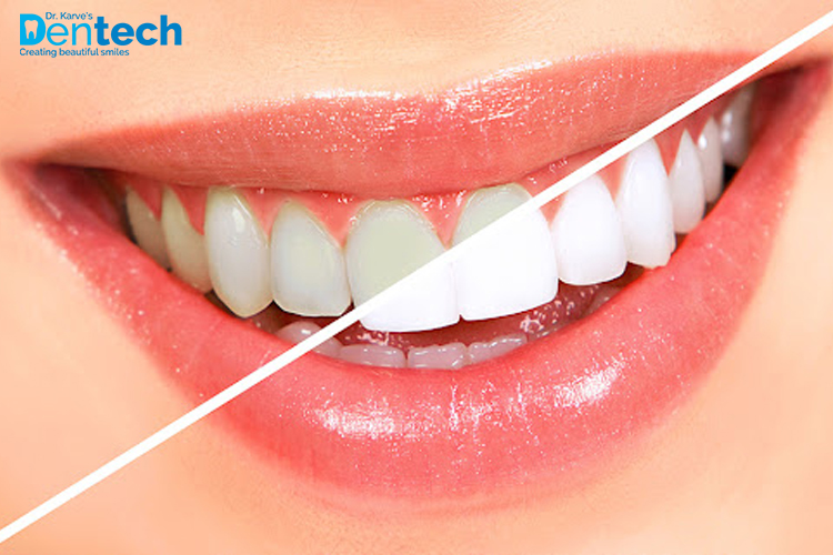 Teeth Whitening
