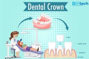 Dental Crown Cost in Mumbai, India &ndash; Dentech